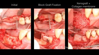 Horizontal ridge augmentation-Block Graft.001