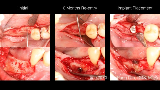 Horizontal ridge augmentation-Block Graft.002