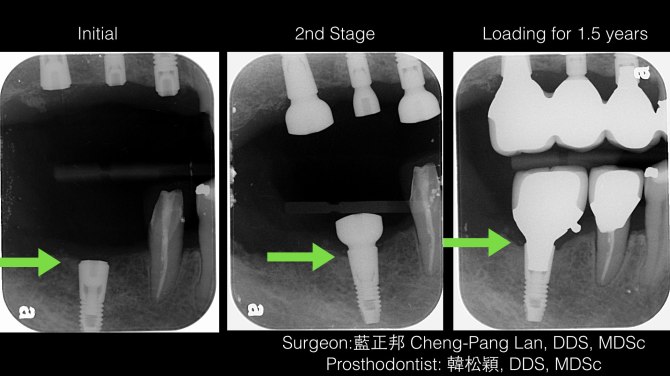Horizontal ridge augmentation-Block Graft.003